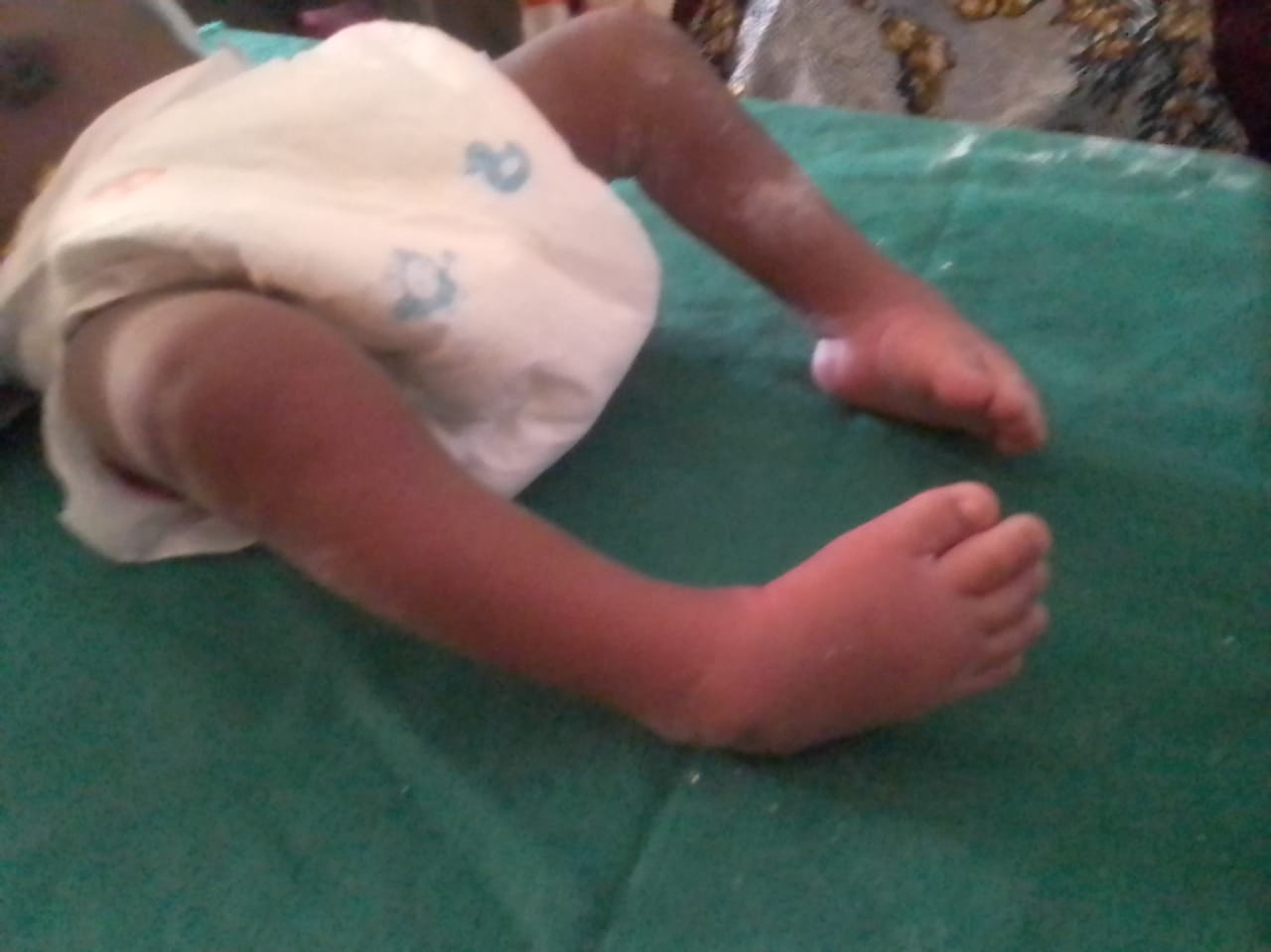 Child with club foot prior to intervention