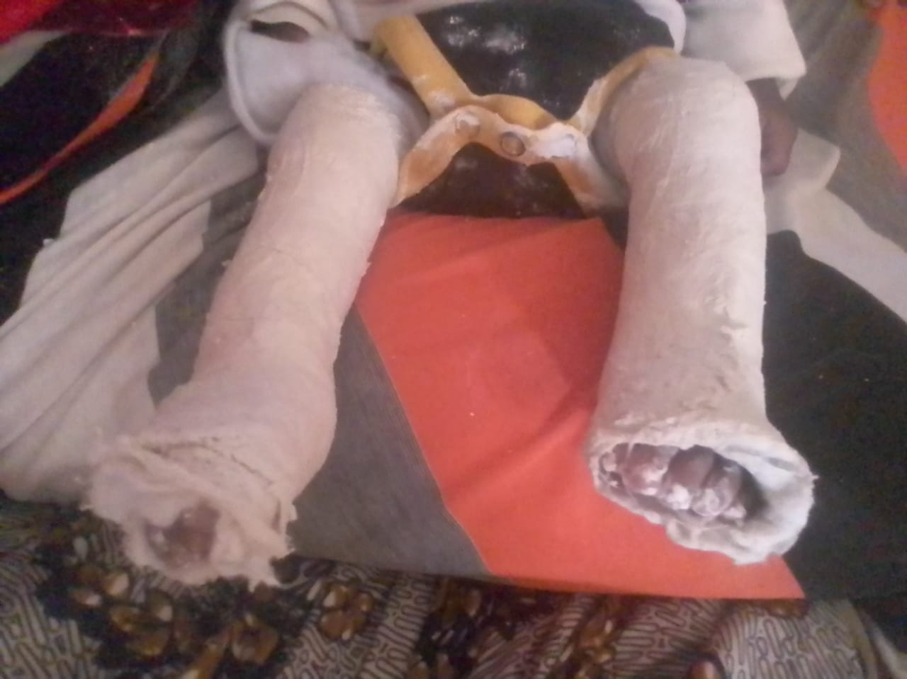 Child's legs in casts undergoing club foot correction